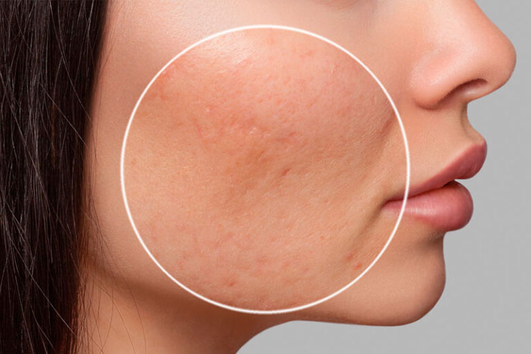 Acné